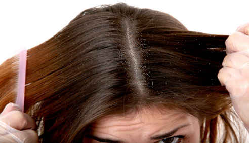 Learn how to prevent and treat your hair dandruff 9 dandruff-remedies