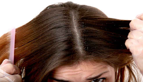 dandruff-remedies1 Learn how to prevent and treat your hair dandruff