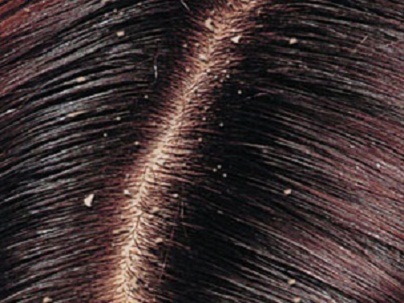 dandruff1 Learn how to prevent and treat your hair dandruff