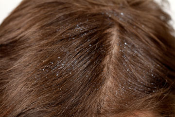 Learn how to prevent and treat your hair dandruff 11 treat-dandruff-1