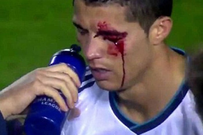 Cristiano-Ronaldos-eye-injury-1432571 Cristiano Ronaldo the Best Football Player & the Greatest of All Time