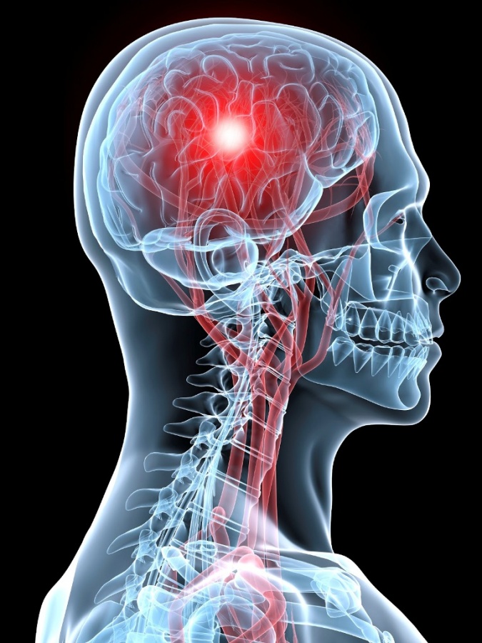 What Are the Risks of Sleeping Less Than 6 Hours a Night? 8 strokebrainimage