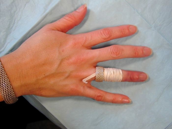 ringRem2 Easy Tricks to Remove a Tight Finger Ring