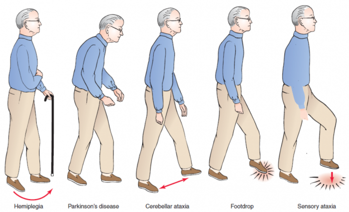 Capture How To Cure and What To Avoid in Parkinson’s Disease?