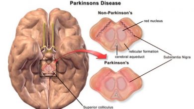 Copy of parkinsons disease brain differences How To Cure and What To Avoid in Parkinson’s Disease? - 8