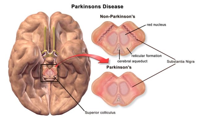 Copy of parkinsons disease brain differences How To Cure and What To Avoid in Parkinson’s Disease? - movement disorders 1