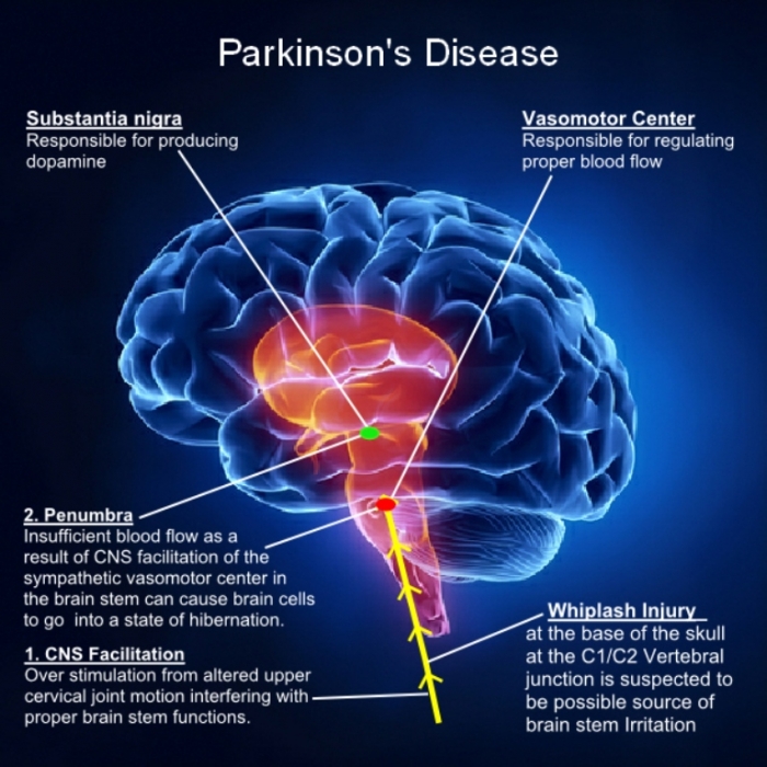 Parkinson-Illustration2 How To Cure and What To Avoid in Parkinson’s Disease?