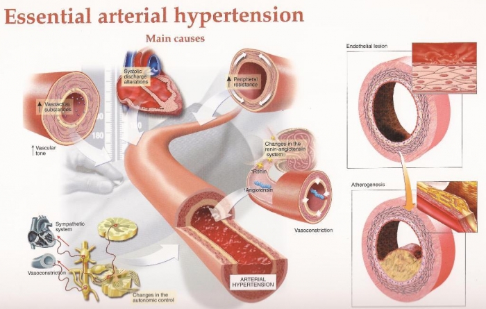 hypertension-21