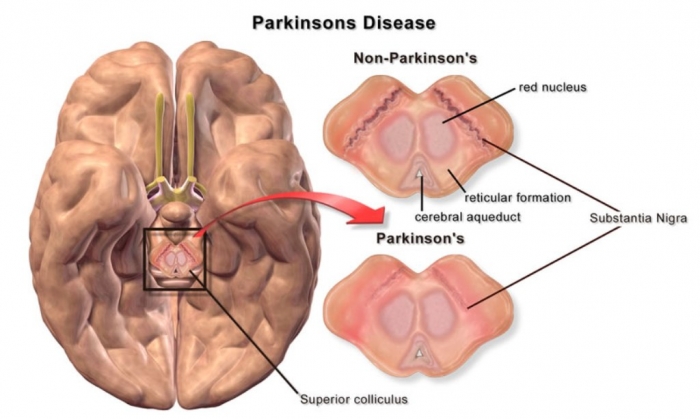 How To Cure and What To Avoid in Parkinson’s Disease? 5 parkinsons-disease-brain-differences