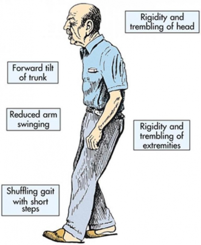 How To Cure and What To Avoid in Parkinson’s Disease? 6 parkinsons-disease.