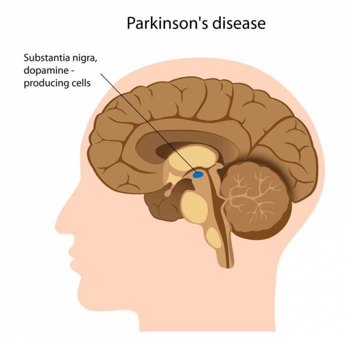 How To Cure and What To Avoid in Parkinson’s Disease? 3 pd-brain-pic