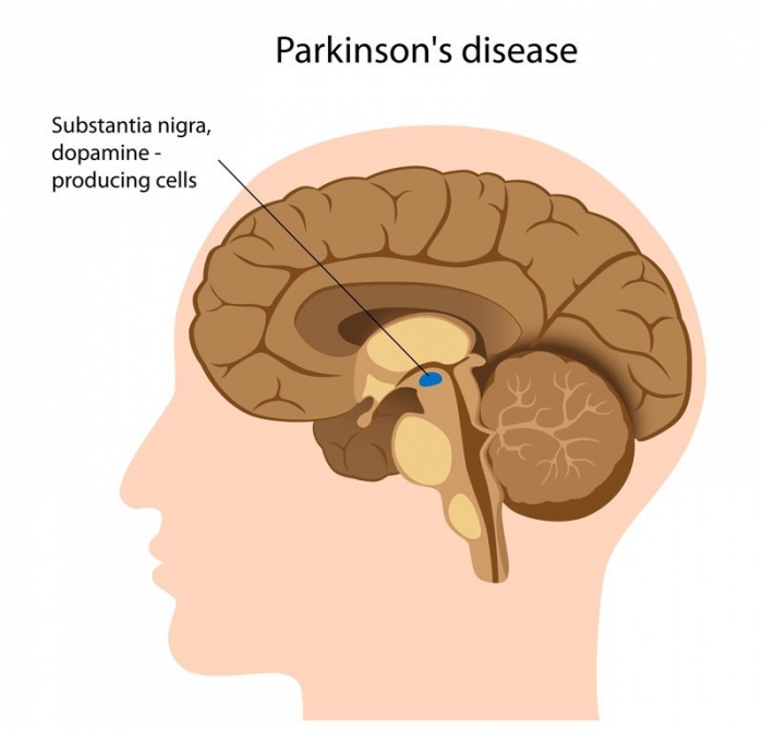 pd-brain-pic How To Cure and What To Avoid in Parkinson’s Disease?