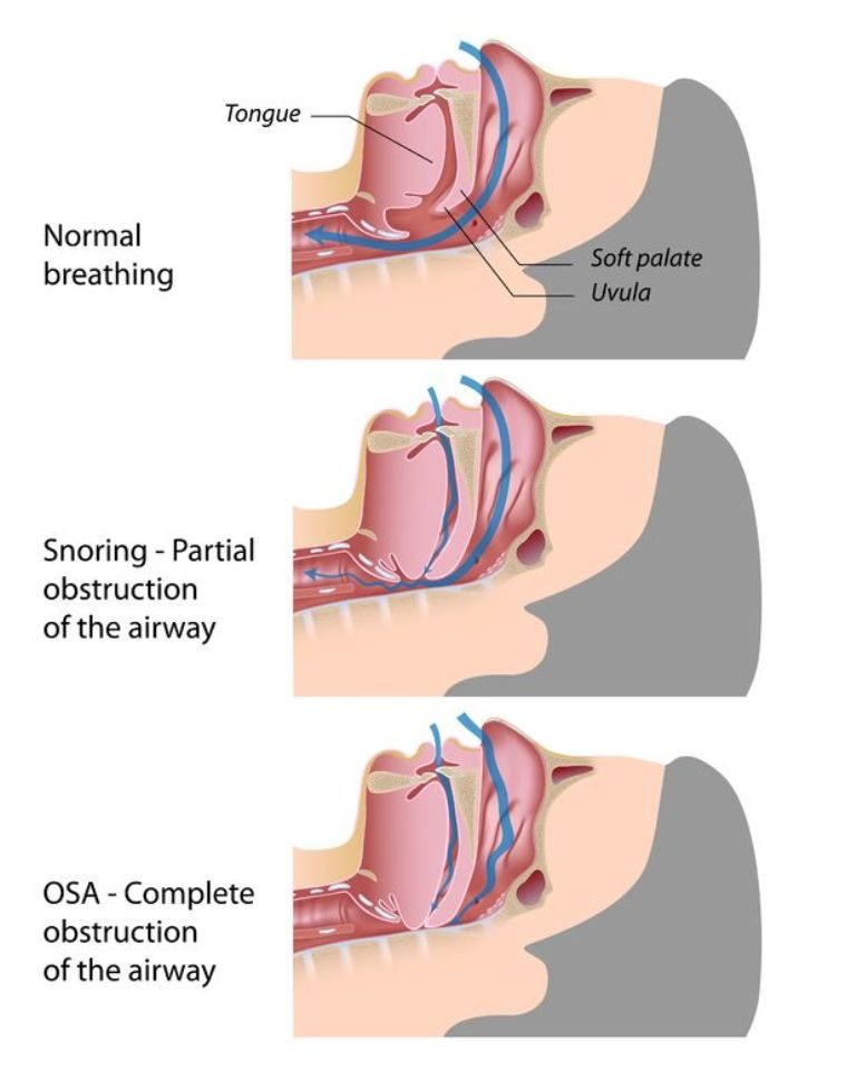 how-snoring-happens How To Get Rid Of Snoring Problem Once And For All