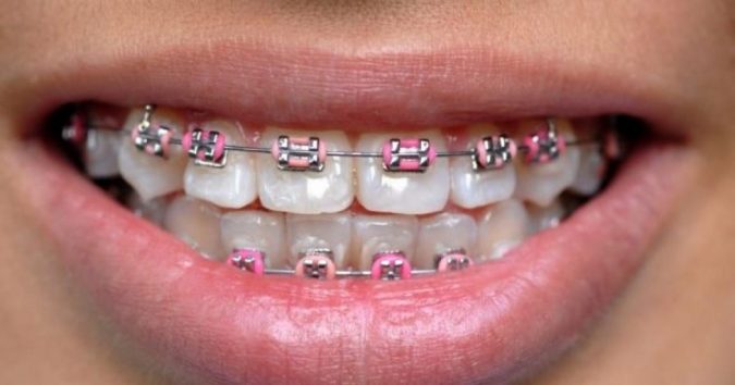 9 Unusual «Hello Kitty» Products! 17 Hello Kitty retainer 9 Unusual «Hello Kitty» Products! - 17