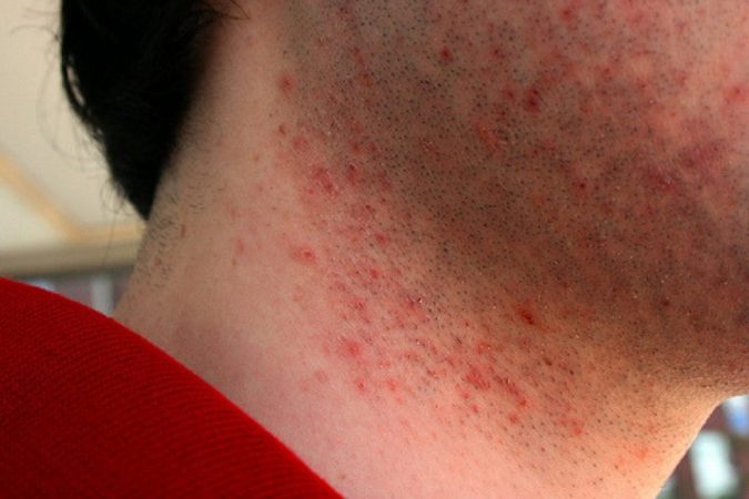 how to Avoid and Soothe Adios razor burns! 7 razor burns how to Avoid and Soothe Adios razor burns! - 7