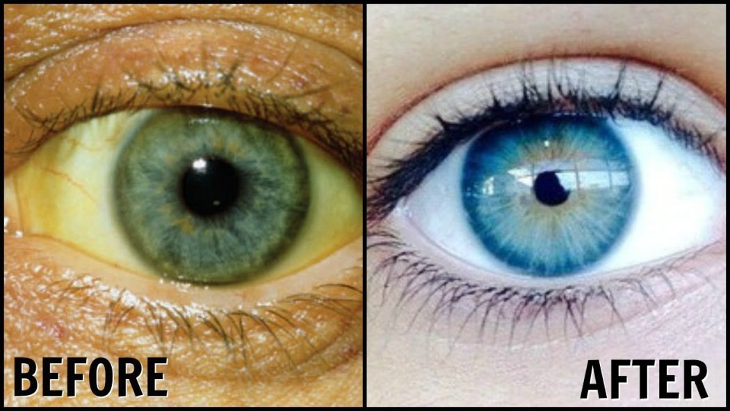 yellowish eyes Get Whiter Eye Whites with These 7 Exclusive Tips! - 3