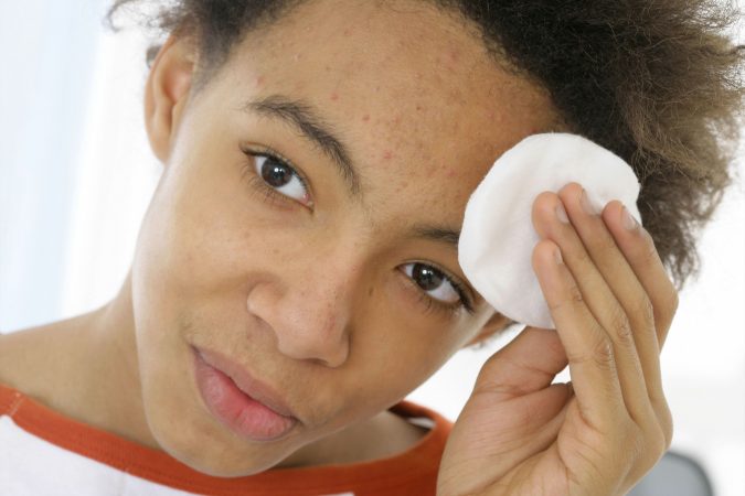 Teen with Mild acne 9 Face Mapping Acne Spots and What Every Acne Spot Means? - 9