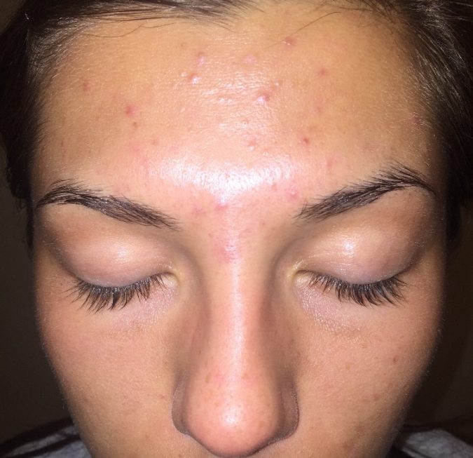 acne-in-the-middle-of-eyebrows-area-675x653 9 Face Mapping Acne Spots and What Every Acne Spot Means?