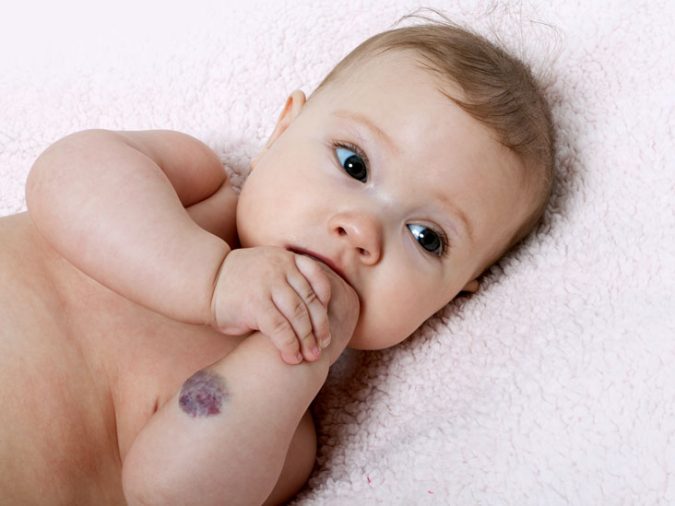birthmarks red thumb laser birthmarks removal Top 10 Shocking Facts about Laser Hair Removal - 5