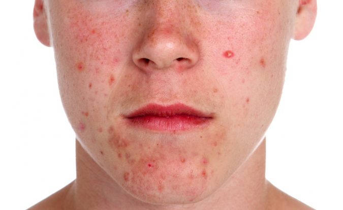 facial chain acne 9 Face Mapping Acne Spots and What Every Acne Spot Means? - 15