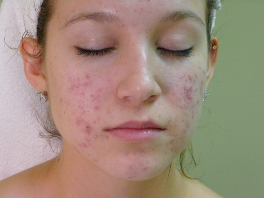 9 Face Mapping Acne Spots and What Every Acne Spot Means? 