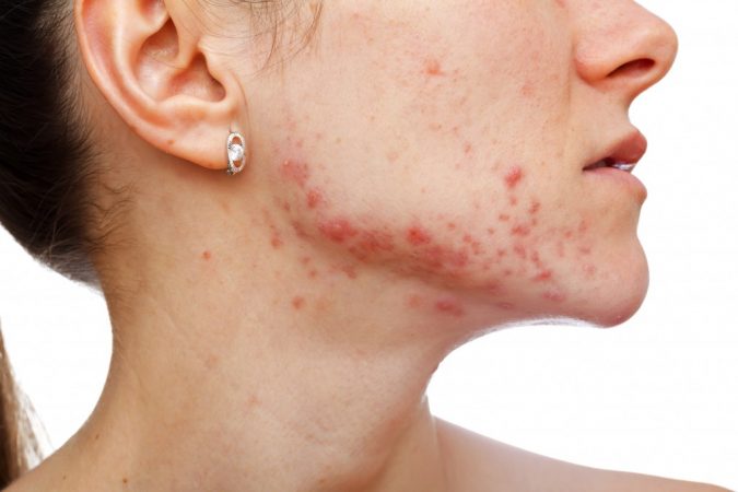 facial-jaw-border-acne-2-675x450 9 Face Mapping Acne Spots and What Every Acne Spot Means?