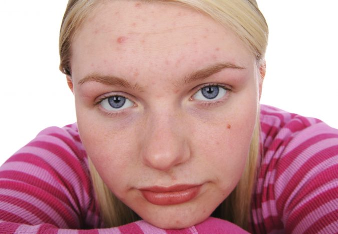 forehead-acne-teenage-girl-675x467 9 Face Mapping Acne Spots and What Every Acne Spot Means?