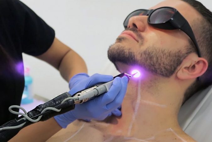 laser hair removal 4 Top 10 Shocking Facts about Laser Hair Removal - 8
