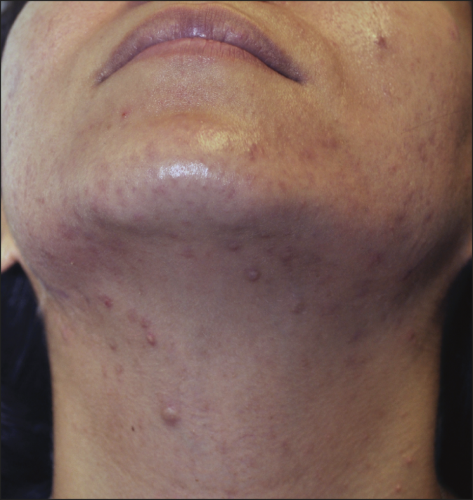 neck-acne-675x713 9 Face Mapping Acne Spots and What Every Acne Spot Means?