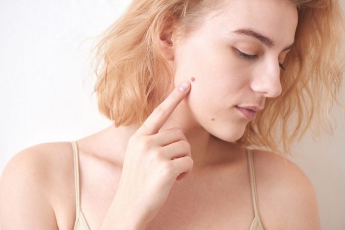 beauty mark Easiest 7 Ways to Get Rid of Beauty Marks - 13