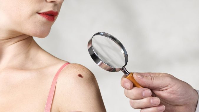 beauty-mark-moles-removed-surgery-675x380 Easiest 7 Ways to Get Rid of Beauty Marks
