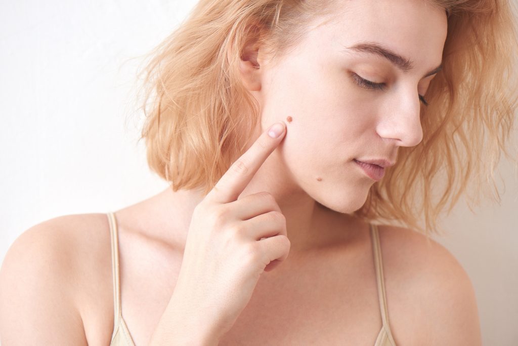 beauty mark Easiest 7 Ways to Get Rid of Beauty Marks - 5 depression