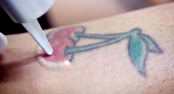 tattoo removal with laser 2 8 Easiest Remedies to Remove Skin Tattoo - 2
