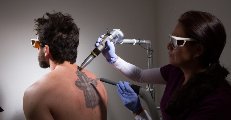 8 Easiest Remedies to Remove Skin Tattoo 1 tattoo removal with laser 8 Easiest Remedies to Remove Skin Tattoo - Tattoo removal 1