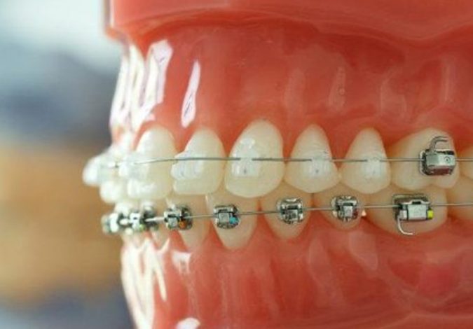 orthodontic-care-675x470 Debunking 7 Common Myths about Orthodontics