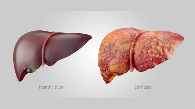 liver cirrhosis Top 10 Food Supplements That Can Ruin the Liver - 16