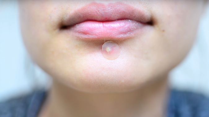15 Best-Selling Beauty Products 21 acne patch on chin 15 Best-Selling Beauty Products - 21