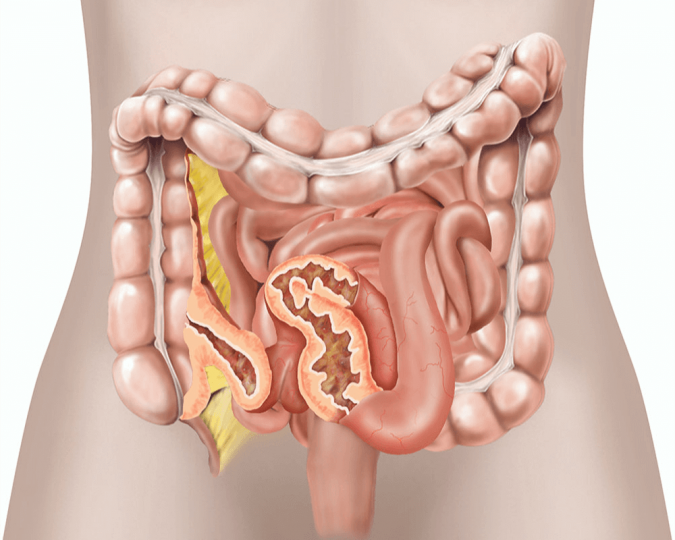 Top 15 Medical Uses of CBD Oil That You Should Know 17 Crohn’s Disease Top 15 Medical Uses of CBD Oil That You Should Know - 17