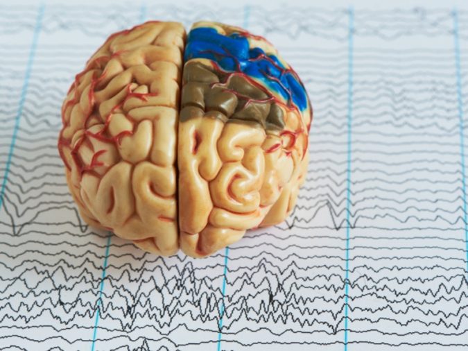 Top 15 Medical Uses of CBD Oil That You Should Know 9 brain Epileptic seizures Top 15 Medical Uses of CBD Oil That You Should Know - 9