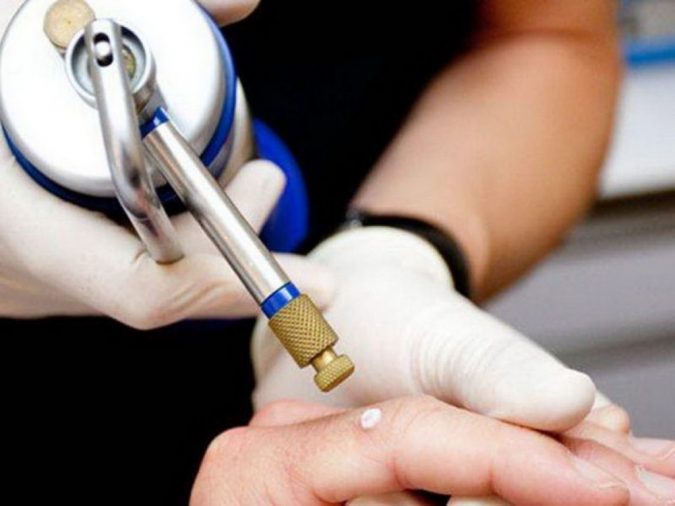 What You Need to Know about Pearly Penile Papules 3 Cryosurgery What You Need to Know about Pearly Penile Papules - 3