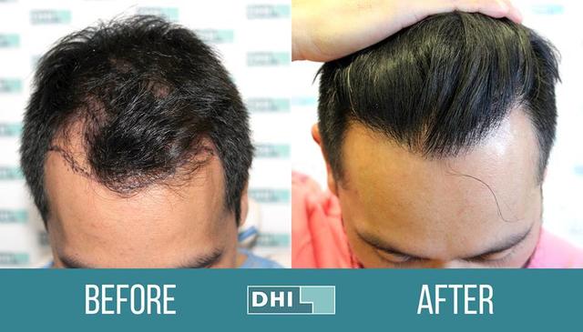 DHI-Medical-Group-hair-transplant-2 Top 10 Hair Transplant Clinics in the UK