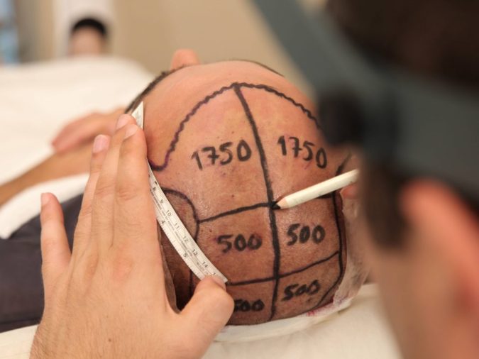 Top 10 Best Hair Transplant Clinics in Turkey 8 Hair Transplant 3 Top 10 Best Hair Transplant Clinics in Turkey - 8