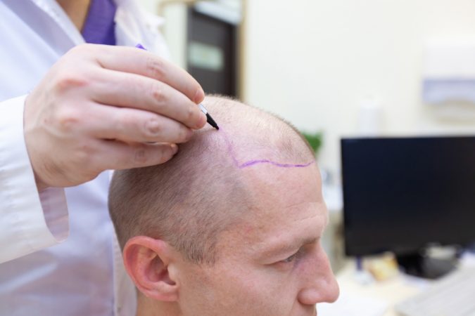 Top 10 Best Hair Transplant Clinics in Turkey 22 Hair Transplant 4 Top 10 Best Hair Transplant Clinics in Turkey - 22