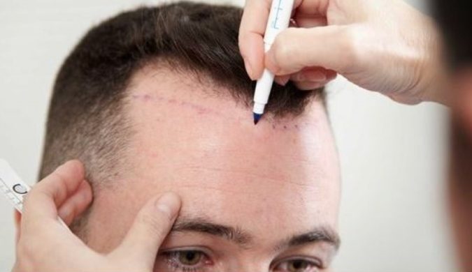 Hair Transplant. 5 Top 10 Hair Transplant Clinics in the USA - 17