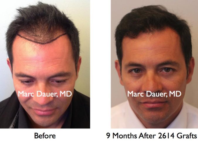 Marc Dauer MD Top 10 Hair Transplant Clinics in the USA - 11