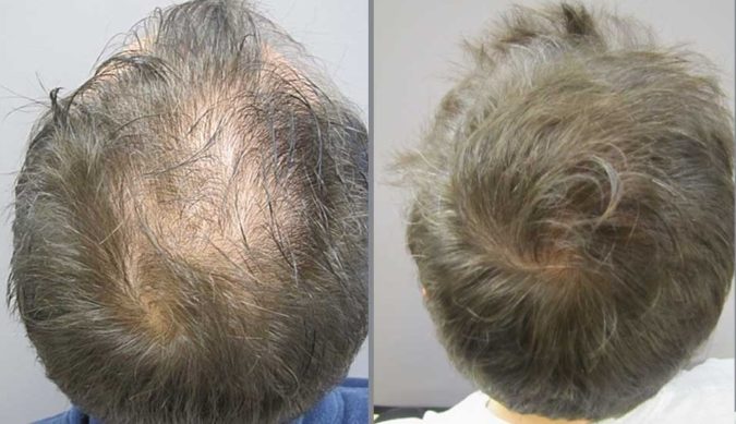 Mollura Medical Hair Restoration Top 10 Hair Transplant Clinics in the USA - 21