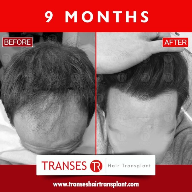 Top 10 Best Hair Transplant Clinics in Turkey 23 Transes hair transplant center 1 Top 10 Best Hair Transplant Clinics in Turkey - 23