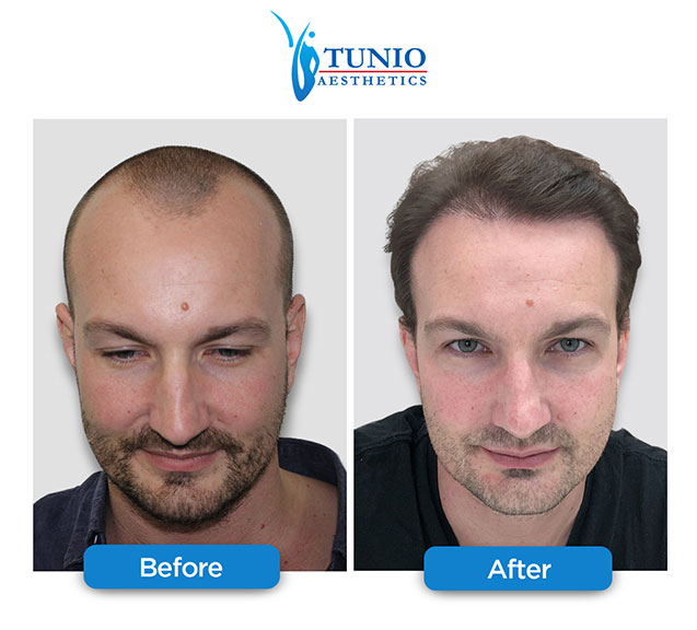 Best 10 Hair Transplant Clinics in Dubai 18 Tunio Aesthetics DHCC hair transplant Best 10 Hair Transplant Clinics in Dubai - 18