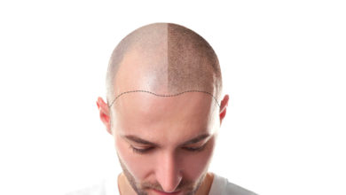 Top 10 Best Hair Transplant Clinics in Turkey 35 UK Hair Transplant Clinics Top 10 Best Hair Transplant Clinics in Turkey - 35