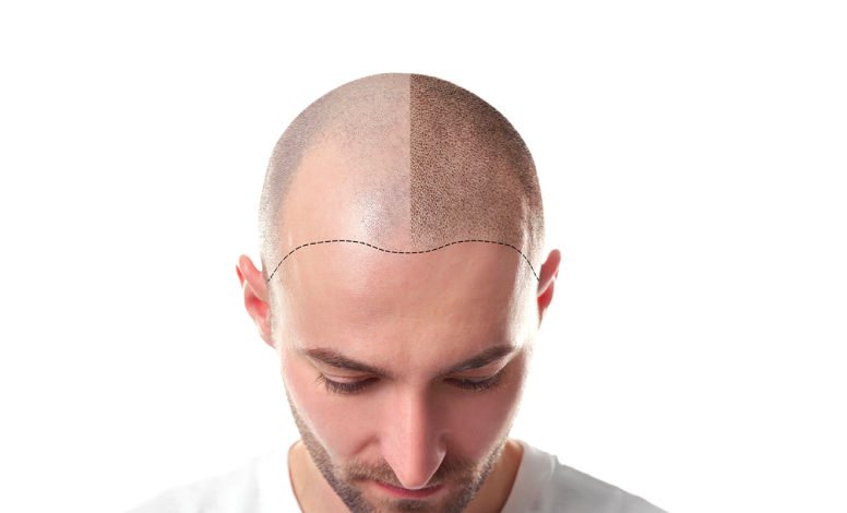 UK Hair Transplant Clinics Top 10 Best Hair Transplant Clinics in Turkey - Clinics In Turkey 1